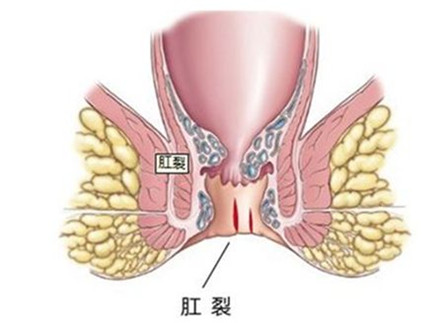 嘉定肛裂痔疮手术多少钱