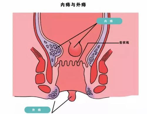 混合痔手术后多久恢复