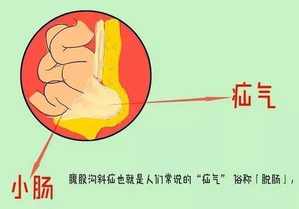 别以为“疝气”是小事，解除烦恼微创手术少不了！