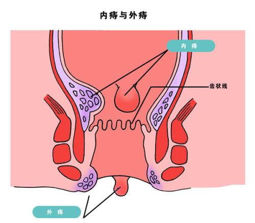 外痔疮手术多少钱左右