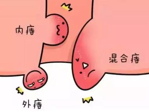 混合痔疮的症状有哪些