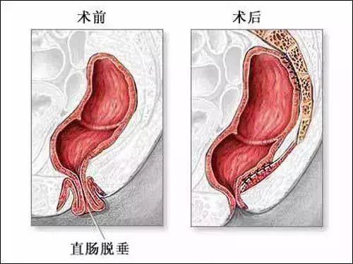 产后脱肛怎么才能恢复